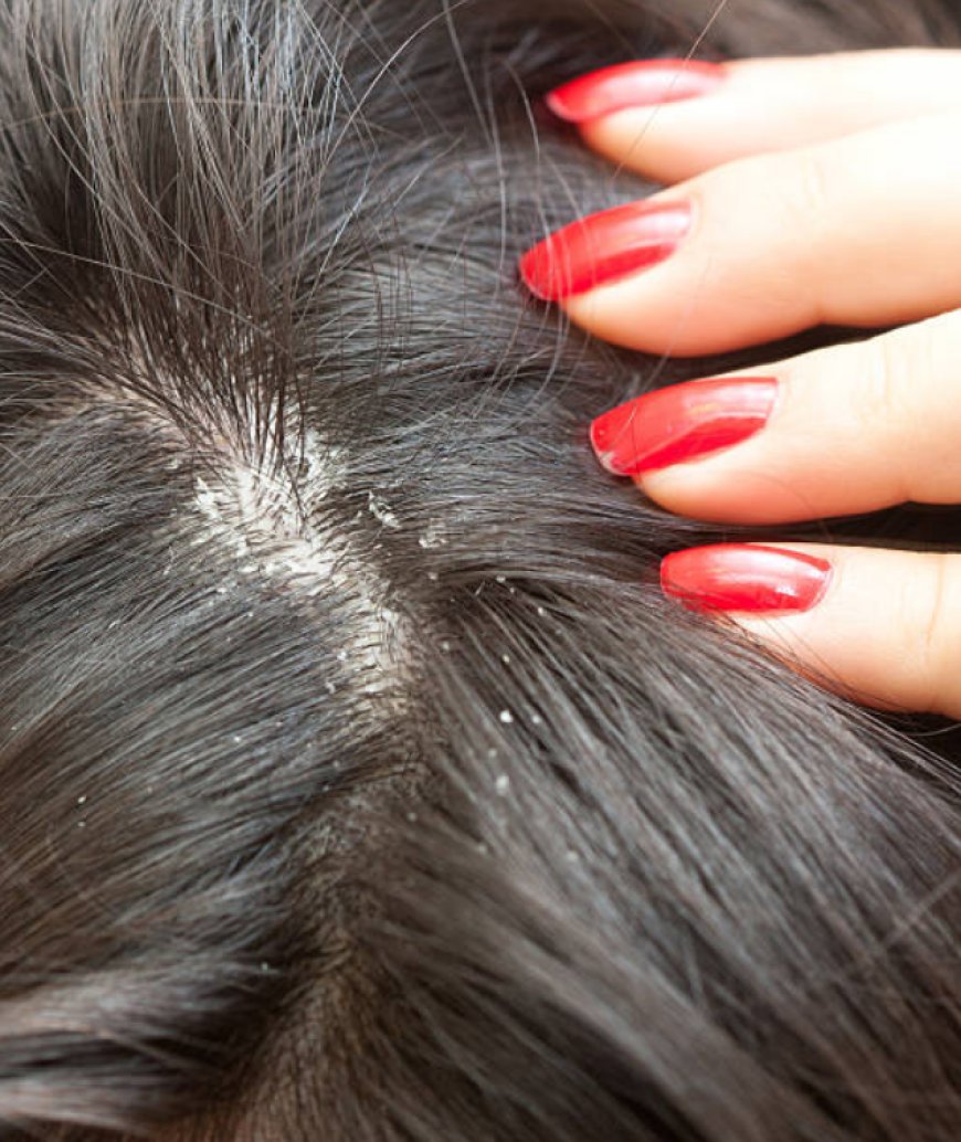 What are some effective home remedies or natural treatments specifically targeting dandruff during the winter months?
